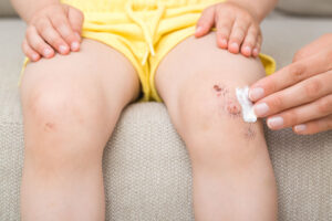 Mother fingers applying medical ointment on abrasion knee skin of toddler. Source:  fotoduets-stock.adobe.com